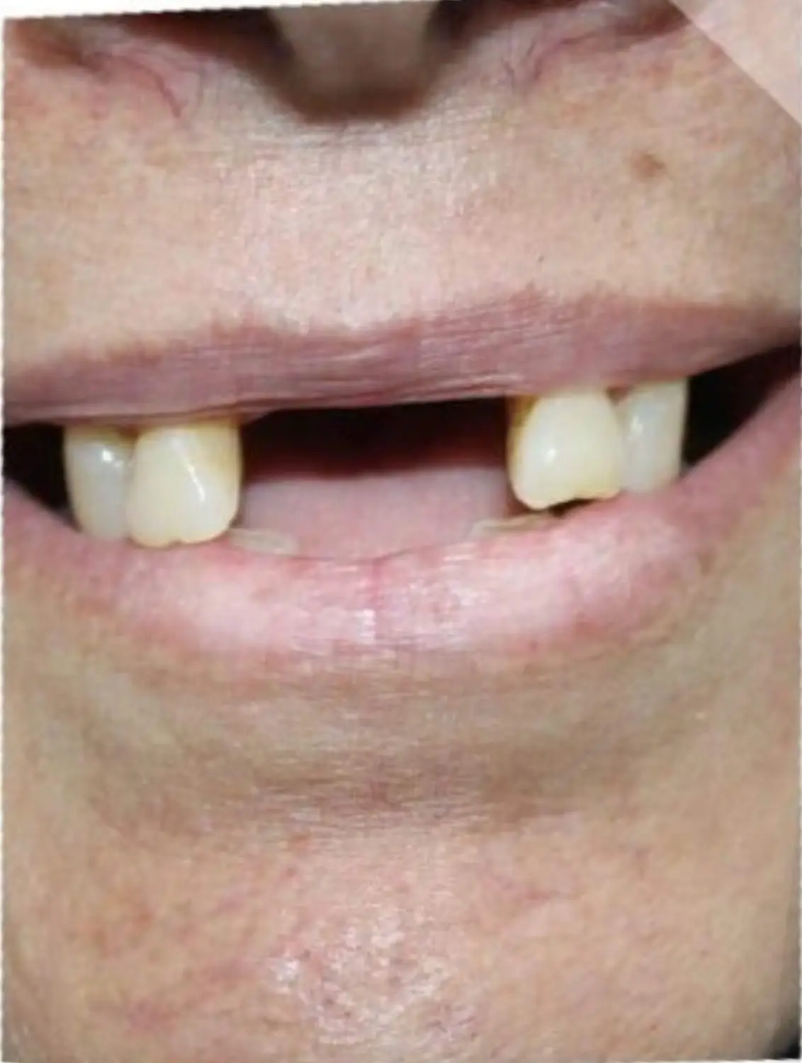 Before treatment - تحول كامل للابتسامة واستعادة الأسنان المفقودة بتركيبات الزيركون الألمانية