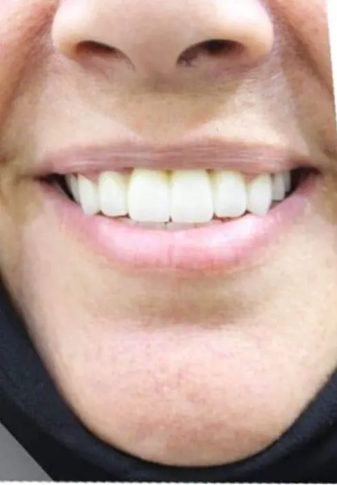 After treatment - تحول كامل للابتسامة واستعادة الأسنان المفقودة بتركيبات الزيركون الألمانية