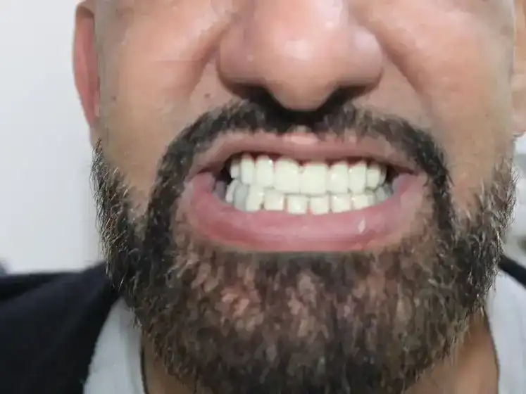 After treatment - استعادة الثقة الكاملة: التأهيل الشامل للفكين بلمسة طبيعية